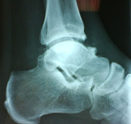X-ray showing a bony spur and an ankle impingement