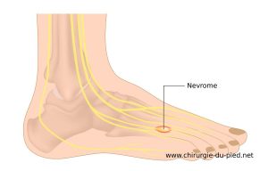 Mechanism and cause of Morton's neuroma.