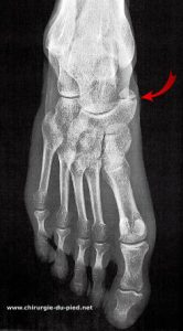 What Is the Accessory Navicular Syndrome? Metmer MD. – Orthopedic Surgeon