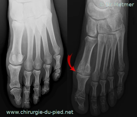 Radiographie: arthrose du gros orteil