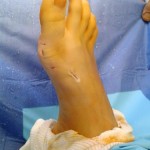 hallux valgus pathologie traitement chirurgie du pied bordeaux 3
