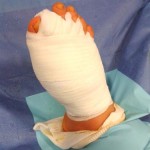 hallux valgus pathologie traitement chirurgie du pied bordeaux 4