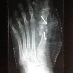 hallux valgus pathologie traitement chirurgie du pied bordeaux 5